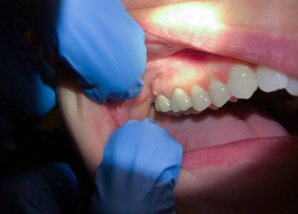 Best Emergency Treatment for Dental Infections or Abscesses in Mayo, MD