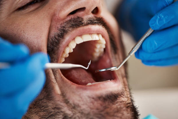 Best Emergency Treatment for Dental Infections or Abscesses in Mayo, MD